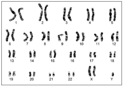 What Does An Abnormal Karyotype Show Karyotypinghub Chromosome