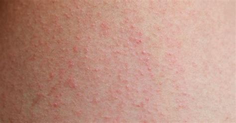 How To Dry Eczema Livestrongcom