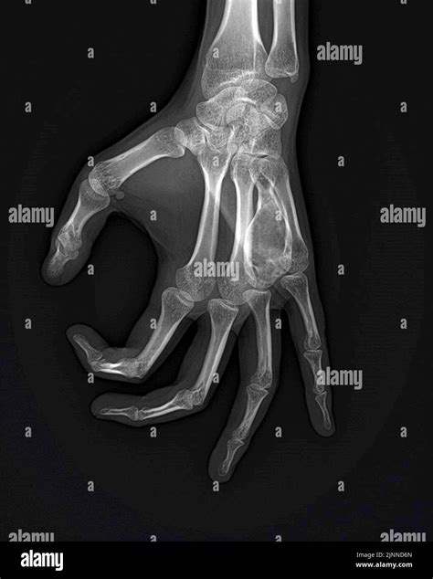 Aneurysmal Bone Cysts Of The Hand X Ray Stock Photo Alamy