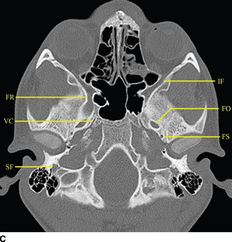 Ventral And Central Skull Base Sinonasal Sellar Parasellar And