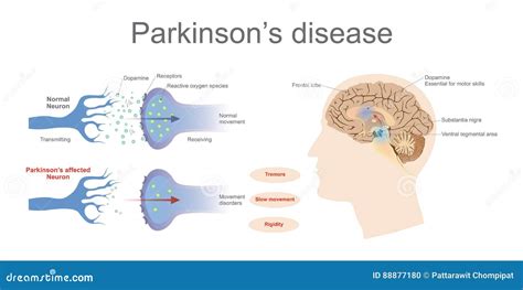 Parkinson`s Disease As A Burden And Weight On Shoulders Symbolized By