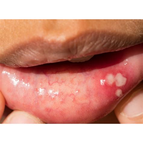 Canker Sores What They Are And How To Manage Them Sentinel Mouthguards®