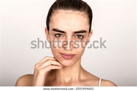 Beautiful Young Girl Problematic Skin Acne Stock Photo 1091494601