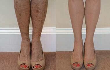 Spots On Legs Causes Home Remedy And Prevention