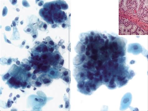 Atypical Glandular Cells Agc Cytology Of Glandular Lesions Of The Uterine Cervix Cytojournal