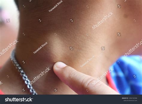 Lymphadenitis 이미지 스톡 사진 및 벡터 Shutterstock