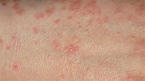 Scabies Rash Causes Signs Home Remedies Pictures Images
