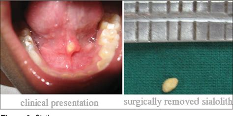 Figure 6 From Submandibular Sialolithiasis Report Of Six Cases