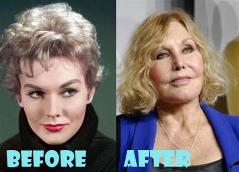 Kim Novak Plastic Surgery Before And After Pictures Lovely Surgery