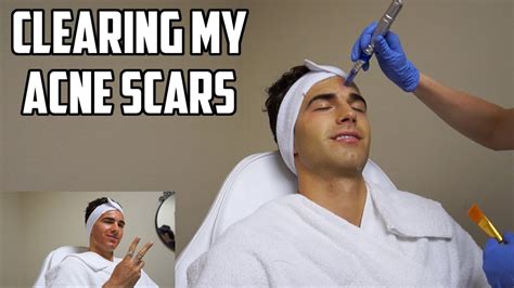 Clearing Up My Acne Scars Microneedling Youtube