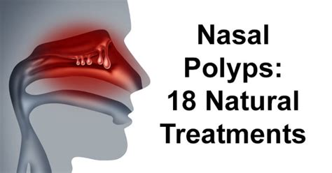 Nasal Polyps 18 Natural Treatments David Avocado Wolfe