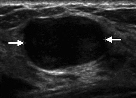 Us Of Breast Masses Categorized As Bi Rads 3 4 And 5 Pictorial