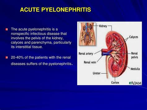 Ppt Acute Pyelonephritis Powerpoint Presentation Id5804875