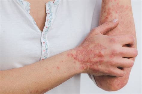 Mengenal Penyakit Autoimun Psoriasis Yang Menyerang Kulit Gejala Dan