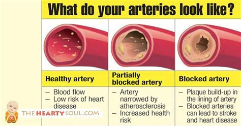 10 possible signs and symptoms of clogged arteries you. Warning Signs Your Arteries are Dangerously Clogged and ...