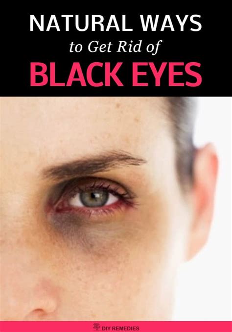 Natural Ways To Get Rid Of Black Eyes