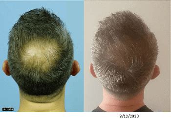For hair loss, 400 billion exosomes per vial are adequate to regenerate hair growth. Hair Loss Cure 2020 | Page 2 of 247 | Hair loss cure news ...