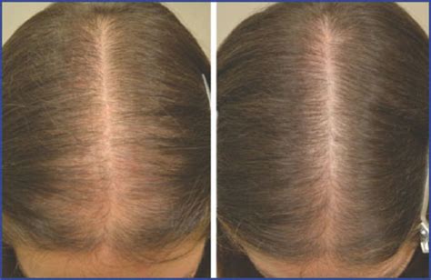 Medical Therapy For Female Pattern Hair Loss Fphl Fphl