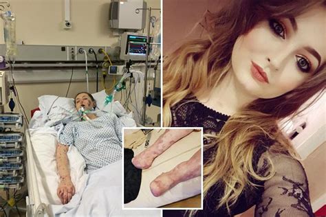 brave meningitis girl s heartbreaking plea for prosthetics using moulds of best pal s feet as