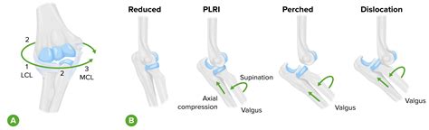 Elbow Dislocation Concise Medical Knowledge