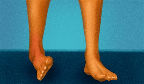 All About Ankle Sprain Types Causes Treatments And More
