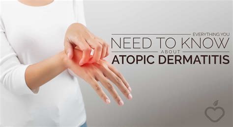 Everything You Need To Know About Atopic Dermatitis Positive Health