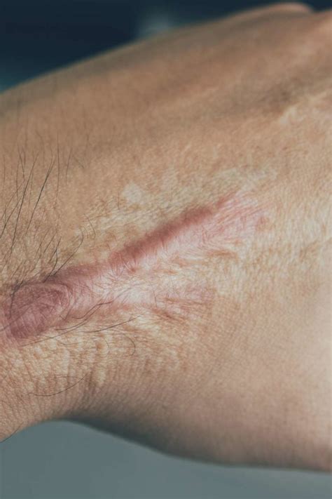 Scar Tissue Causes Prevention And Treatment