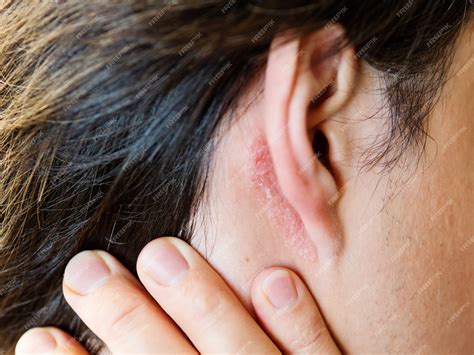 Premium Photo Irritation On The Skin Behind The Ear Man With Flaky
