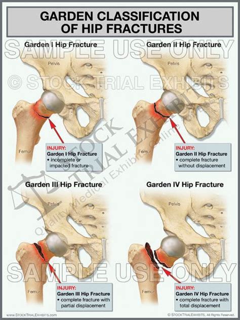 Pin By Michelle Picarella On Fractures Hip Fracture Fractures