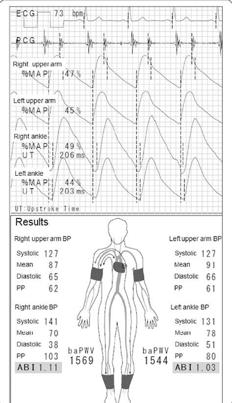 Ankle Brachial Index Measurement By A Volume Plethysmography In Patient