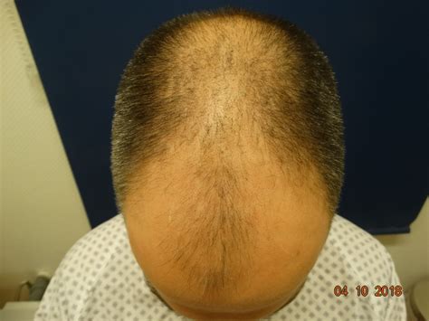 Produktbezug wo und wie produkte gegen haarausfall einkaufen. Haartransplantation Forum : Hairmedic » 4600 FUE Grafts ...