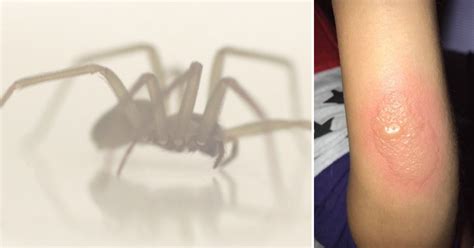 5 Pictures What Does Brown Recluse Spider Bite Look L Vrogue Co