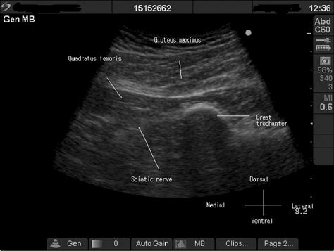 Ultrasound guided sciatic nerve block in the popliteal region is considered a basic skill level block because the nerve is easily visualized. Ultrasound findings of patient's right buttock area and ...