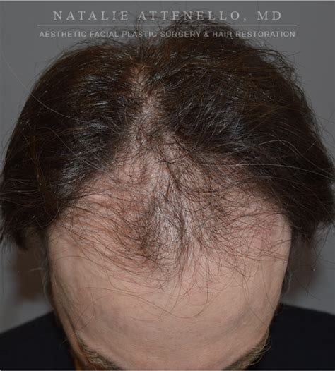 Beverly Hills Hair Restoration Before And After Photos Los Angeles Plastic Surgery Photo