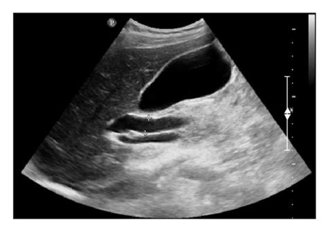 Abdominal Ultrasound Showing A Dilated Common Bile Duct 11 Mm