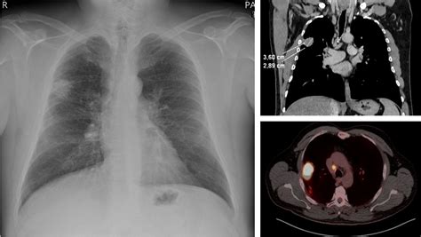 What Is Thoracic Surgery European Society Of Thoracic Surgeons