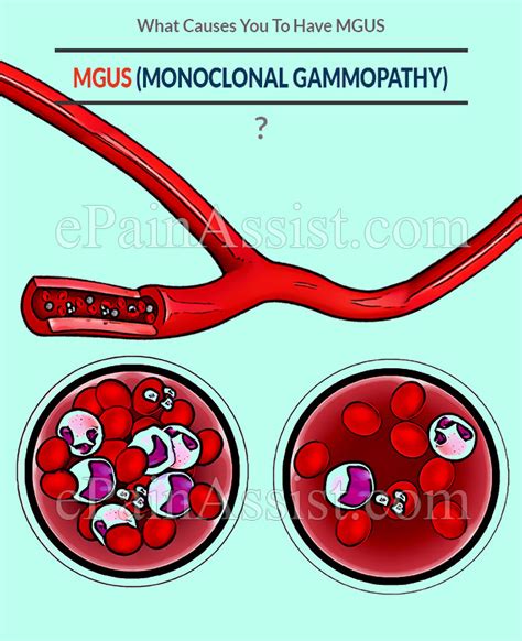 What Causes You To Have Mgus Or Monoclonal Gammopathy Of Undetermined