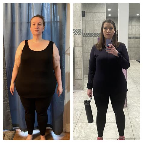 F3553 260lbs 169lbs 91lbs 6 Months Gastric Bypass Has