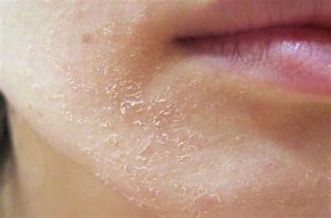Dry Patches On Face Treatment Designgerah