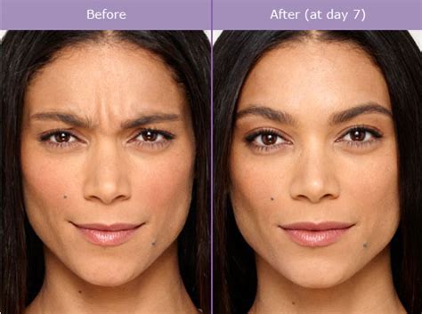 Botox can lift a drooping brow, but it has its botox cosmetic before and after photo gallery. Botox Before and After Photos Miami Beach | South Beach ...