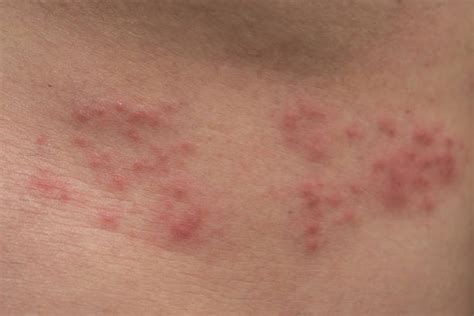 Shingles Rash Stock Photos Pictures And Royalty Free Images Istock