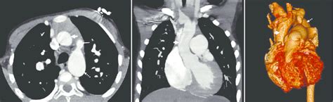 A Axial Contrast Enhanced Computed Tomography B Coronal