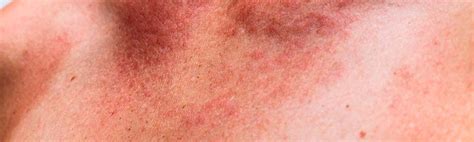 Skin Rash And Sexually Transmitted Diseases Symptoms Types And Differentiation