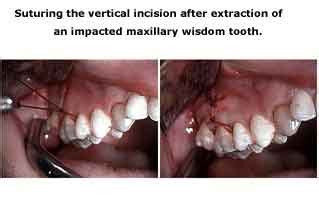 Wisdom Teeth Extraction Full Bony Impaction