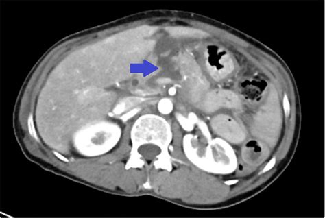 Cect Scan With Arrow Head Showing Complete Transection Of Pancreas With