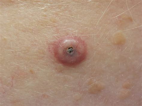 Squamous Cell Skin Cancer On Arm