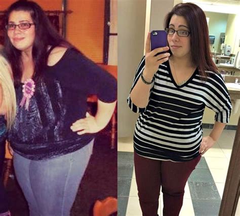 15 Incredible Weight Loss Surgery Before And After Best Product Reviews