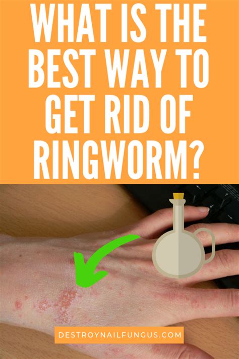 How To Get Rid Of Ringworm On Arm Fast Mang Temon