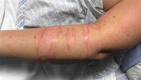 Nursing Photos Nurse Left With Second Degree Burns After Patient