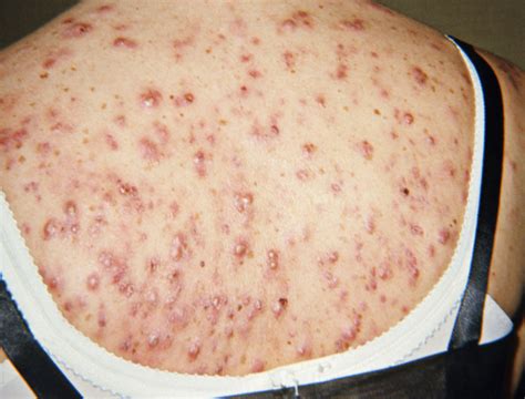 Back Acne Causes Scars Bad Cystic Acne In Adults How To Get Rid